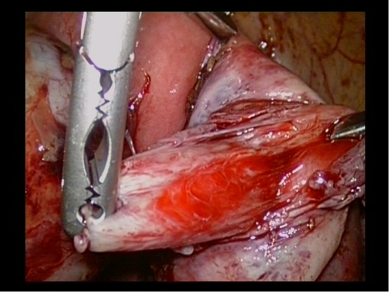 Choclate Endometriotic Cyst Stripping Choclate Endometriotic Cyst Stripping